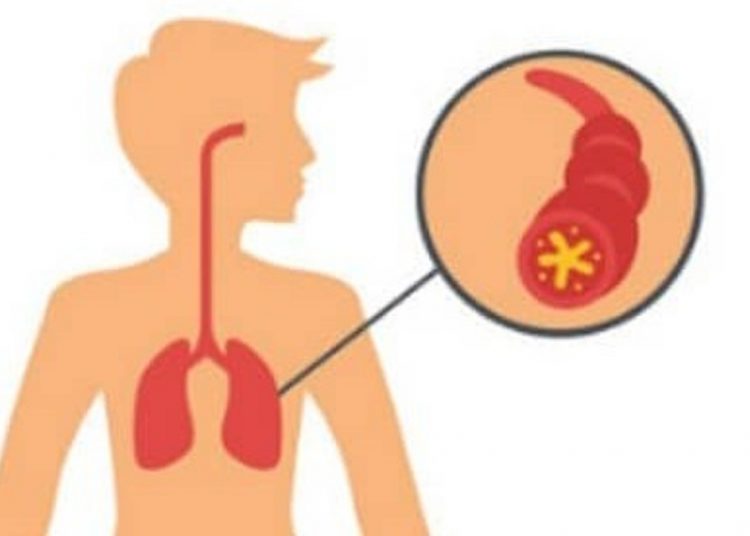 Foto ilustrasi tentang penyakit asma. Data menunjukkan, 4,5 persen penduduk Indonesia menderita asma. (net/ist)
